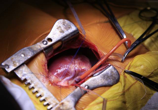 شکافتن قفسه سینه در عمل قلب باز