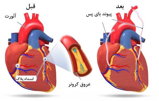 پیوند زدن رگ قلب