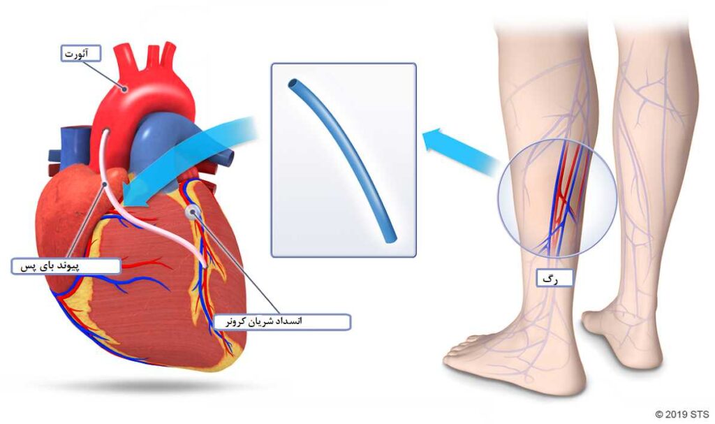 برداشتن رگ از پا برای عمل قلب
