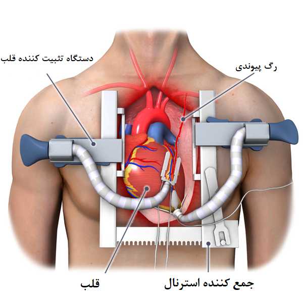 مراحل جراحی بای پس قلب