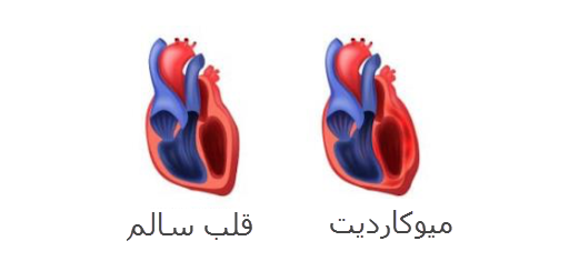 التهاب عضله قلب یا میوکاردیت
