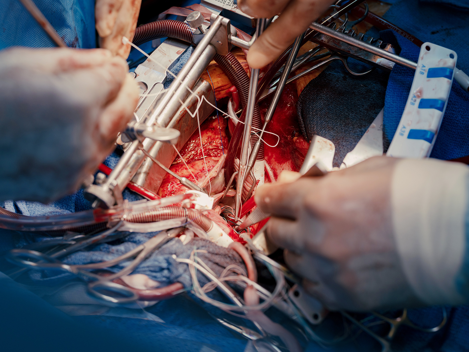 جراحی قلب باز چیست