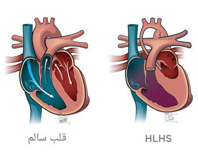 سندرم قلب چپ هیپوپلاستیک