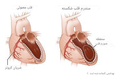 سندرم قلب شکسته