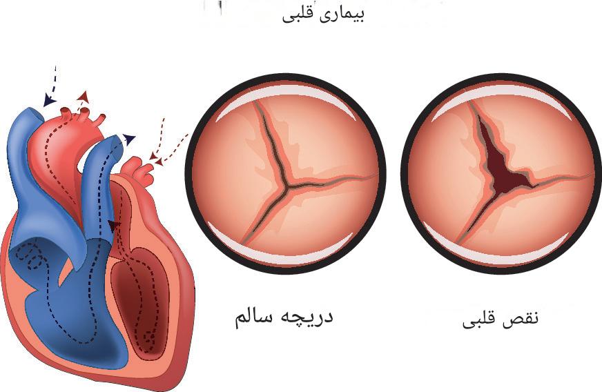 ناهنجاری های مادرزادی دریچه میترال