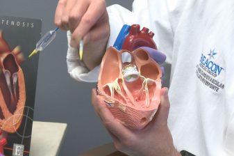 تعویض دریچه قلب بدون جراحی