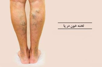 عکس لخته شدن خون در پا
