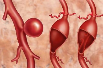 مراقبت های بعد از عمل آنوریسم شکمی