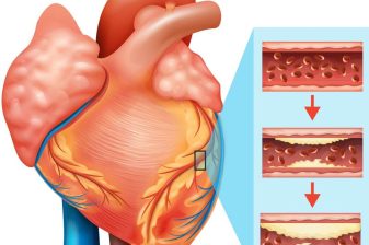 علائم گرفتگی رگ قلب